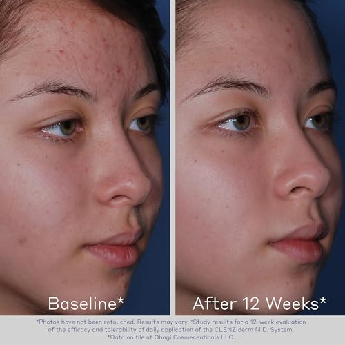 Obagi CLENZIderm M.D. Pore Therapy Exfoliating BHA Toner - Unclogs Pores with 2% Salicylic Acid Acne Treatment – 5 oz - Image 5