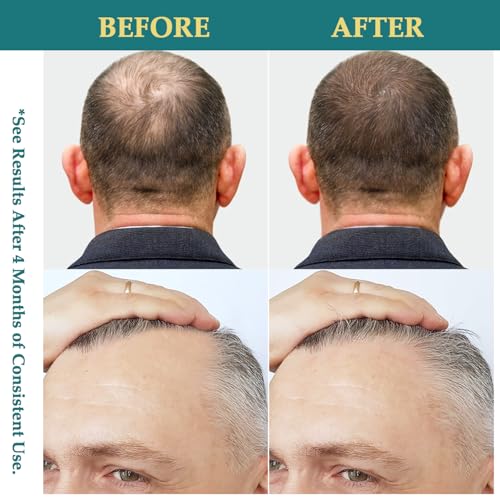 Natural Hair Growth Oil Spray: Batana Rosemary Serum Biotin Caffeine Scalp Care Treatment - Thinning Hair Regrowth Thickening for Women Men 2 FL OZ - Image 4
