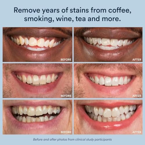 Auraglow Teeth Whitening Strips, Sensitive Whitening Strips, 14 Whitening Treatments, 8% Hydrogen Peroxide with Nano Hydroxyapatite (nHAp) to Reduce Sensitivity and Protect Enamel, 28 Strips, Mint - Image 6