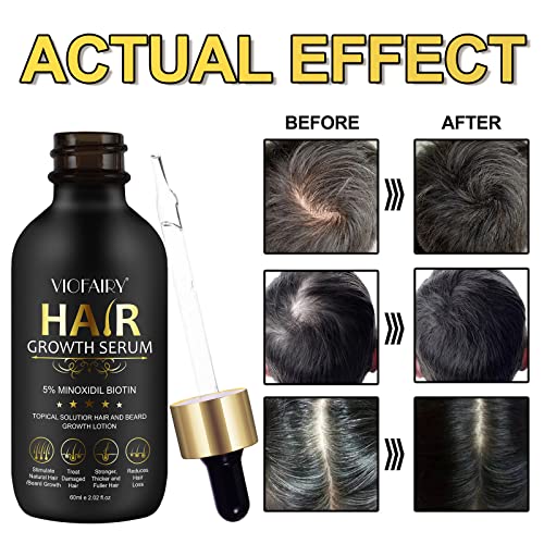 5% Minoxidil for Men and Women Hair Growth Oil, Biotin Serum, Hair Regrowth Treatment for Scalp Hair Loss, Natural, for Thicker Longer Fuller Healthier Hair 2.02 oz - Image 2